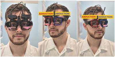 Binocular video head impulse test: Normative data study